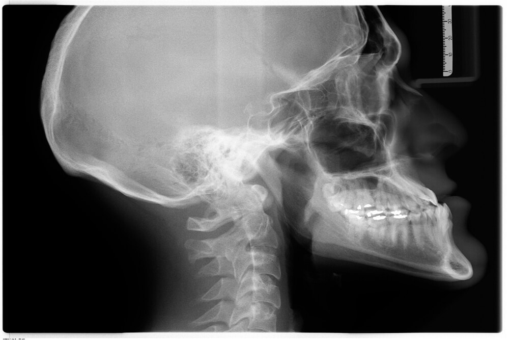 X-ray of skull