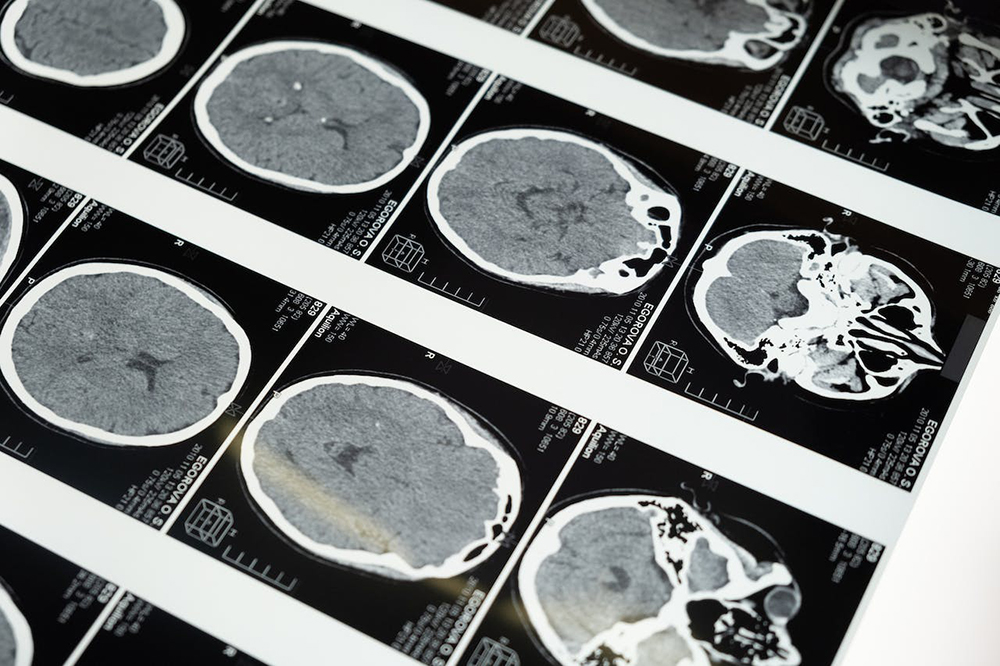 What Types of Brain Injuries Are Caused by Medical Malpractice